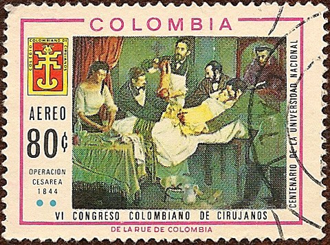 Primera Sesárea 1844 - VI Congreso Colombiano de Cirujanos